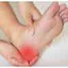 Redness and swelling around the joint