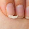 Brittle nails or hair loss