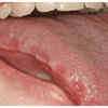 Tooth marks or indentations on the edges
