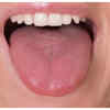 Enlarged or swollen tongue