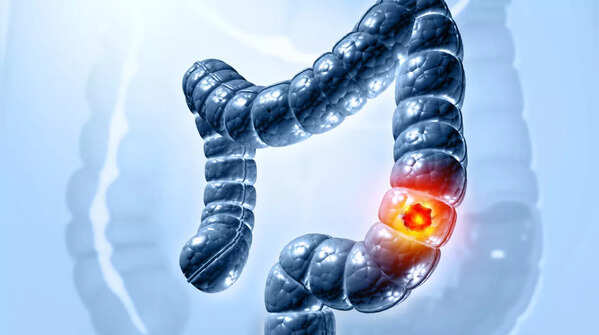 Five common signs of colon cancer that are often ignored