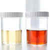 Dark urine and pale stools