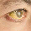 Skin discoloration