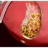 Why do Gallstones form