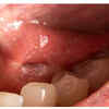 Unexplained lumps or thickening of the tissue