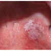 White or red patches inside the mouth