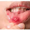 Mouth sores or ulcers that extend beyond a few weeks