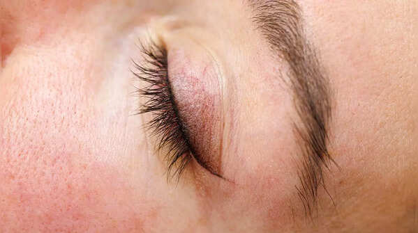 Yellowish deposits on eyelids (Xanthelasma)