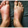 Nail changes on fingers and toes