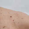 Familial atypical mole and melanoma (FAMMM) syndrome