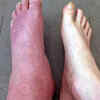 Swelling