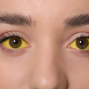 Sudden yellowish patches around the eyes