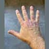 Skin changes near joints