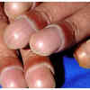 Clubbing of fingers and toes