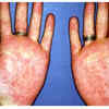 Red palms (Palmar Erythema)