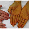 Yellow coloration (Jaundice) of hands and feet
