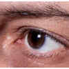 Dark circles or rings around the eyes
