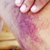 Bruising on legs