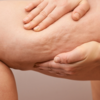 Visible cellulite