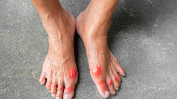 Severe complications of high uric acid levels