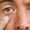 Yellow skin or eyes