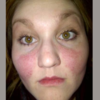 A butterfly rash across the face