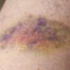 Bruises without a story