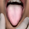 Pale or coated white tongue
