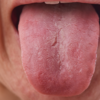 Swollen or puffy tongue