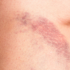 Slow-healing cuts on legs