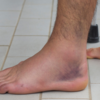 Skin darkening around ankles