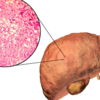 What is fatty liver