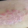 Pruritus