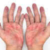 Palmar Erythema