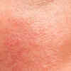 Rosacea