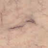 Spider Angiomas