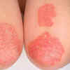 Scaly or rough patches