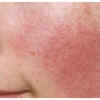 Redness or rosacea on the face