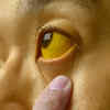 Jaundice and color changes in skin, urine, or stool
