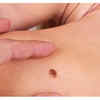 Persistent open sores or craters
