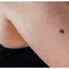 New or changing moles and dark spots