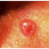 Shiny, pearly or translucent bumps