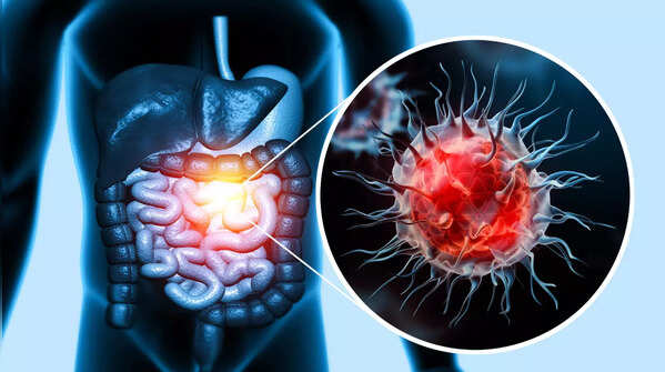 <strong>Colon cancer in youngsters: 4 foods that can reduce the risk and boost health</strong>