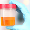 Dark coloured urine