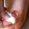 Foot or toe wounds do not heal easily