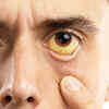 Yellowing of the skin and eyes
