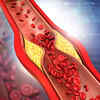 High cholesterol levels