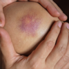 Easy bruising and bleeding