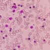 Types of Alpha Thalassemia