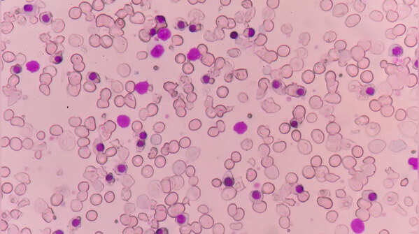 Types of Alpha Thalassemia